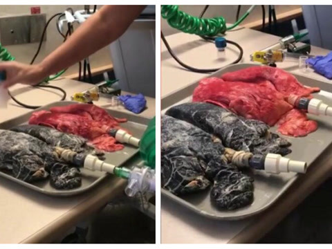 吓人!20年老烟民的肺与健康的肺区别究竟有多大